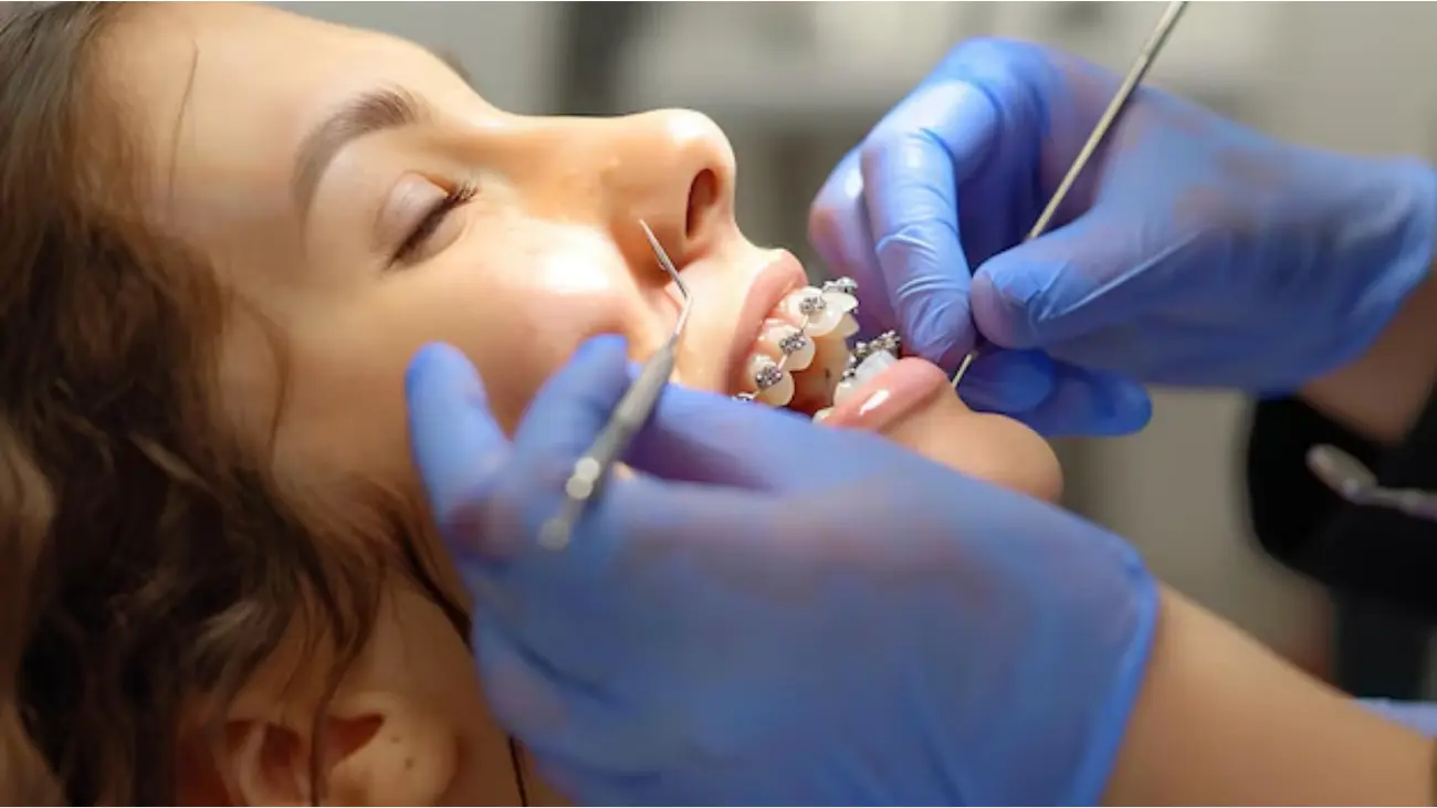 Transformative white metal braces for brighter smiles.